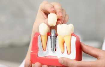 How Denture Support Implants Improve Stability and Comfort?